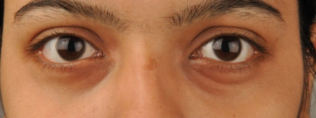 Why Our Under-Eye Area Needs More Care Than We Think