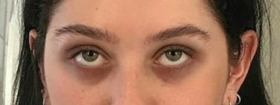 Why Your Under-Eye Area Needs More Than Just Sleep