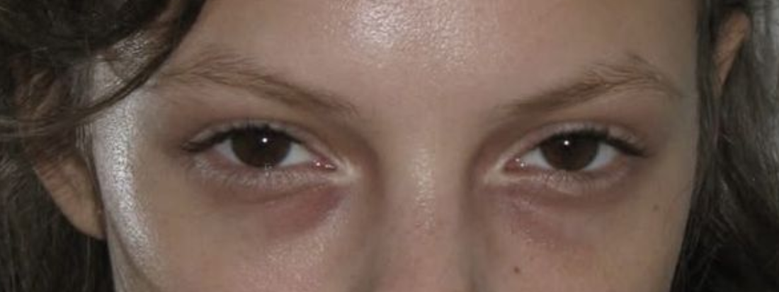 CAN MAKEUP MAKE UNDER-EYE DARKNESS WORSE?
