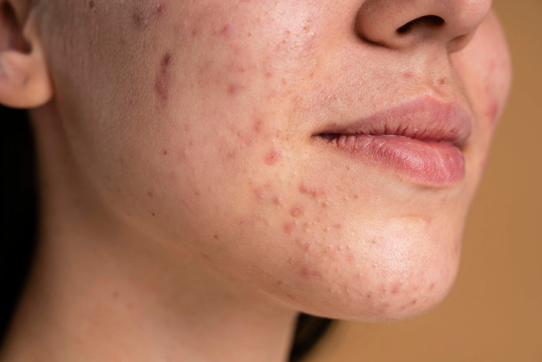 Let Us Talk Clear Skin: Why Tea Tree Face Wash For Acne Actually Works