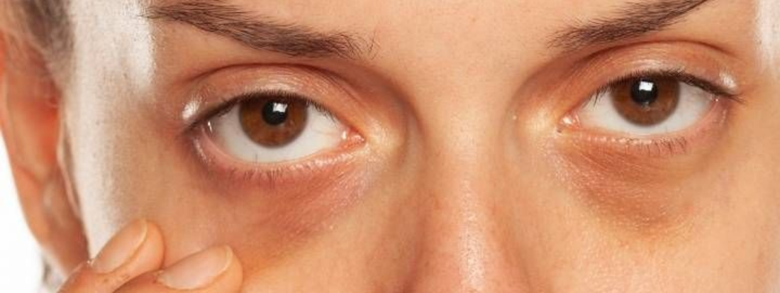 So… Let’s Talk About Under-Eye Care